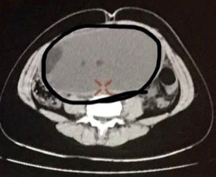 Ruby-Mae vyoperovali veľký tumor.