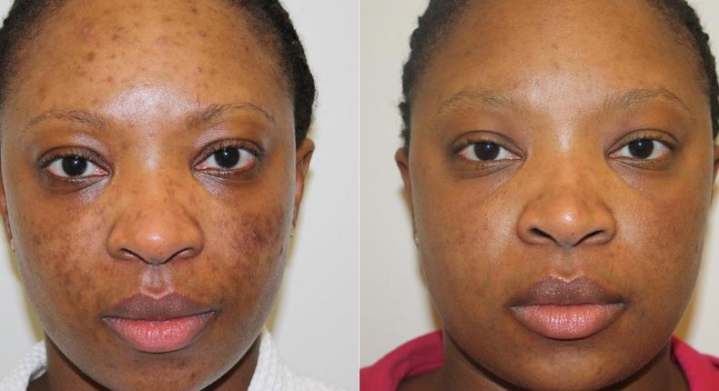 A blemished skin shows improvement after treatment