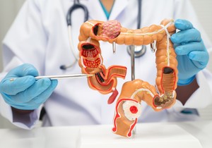 Rak debelog creva sve češće se beleži kod mlađih od 50 godina