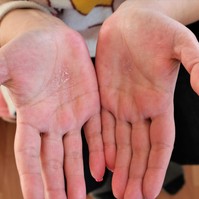 Tenyér-talpi ekcéma: este súlyosabb! Ezt teheti, ha éjszaka viszketni kezd