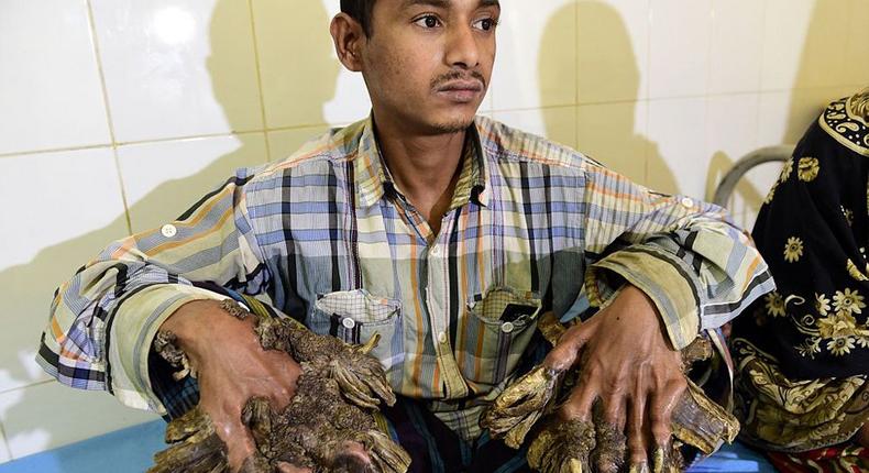 ‘Tree Man’ has surgery to remove bark-like warts on his hands