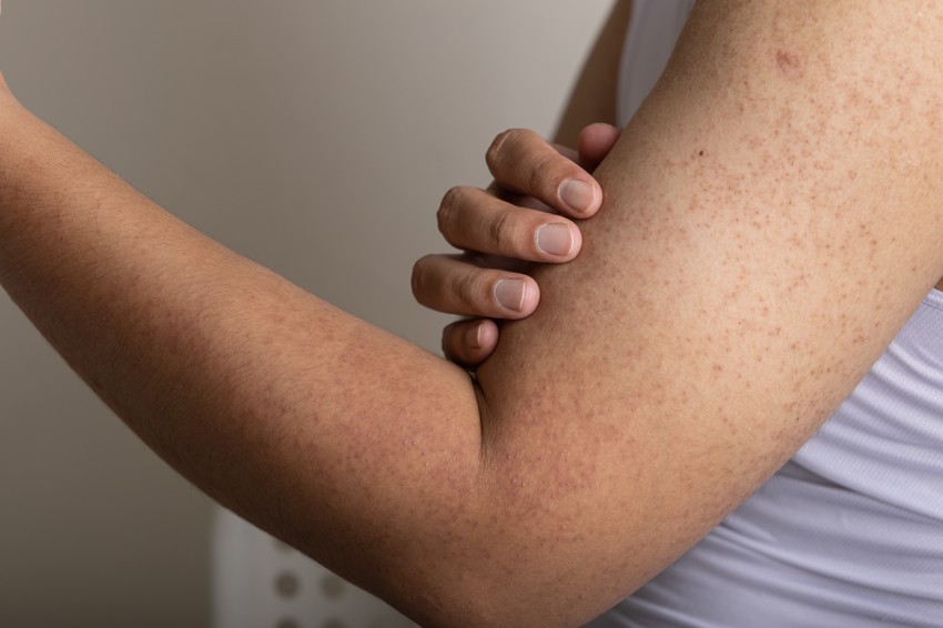 Keratoza pilaris, poznata kao "guščja koža", izaziva hrapave, crvene ili bele kvržice na koži