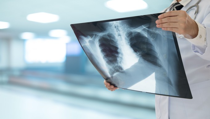 Tüdőgyulladás - még ma is igen veszélyes az influenza gyakori szövődménye
