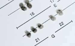 W Polsce żyje 60 tys. osób z zespołem Downa, ponad 70 proc. z nich dożywa ponad 50 lat