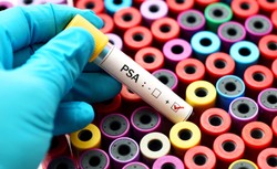 Badanie PSA w kierunku raka prostaty warto wykonywać już od 40. roku życia
