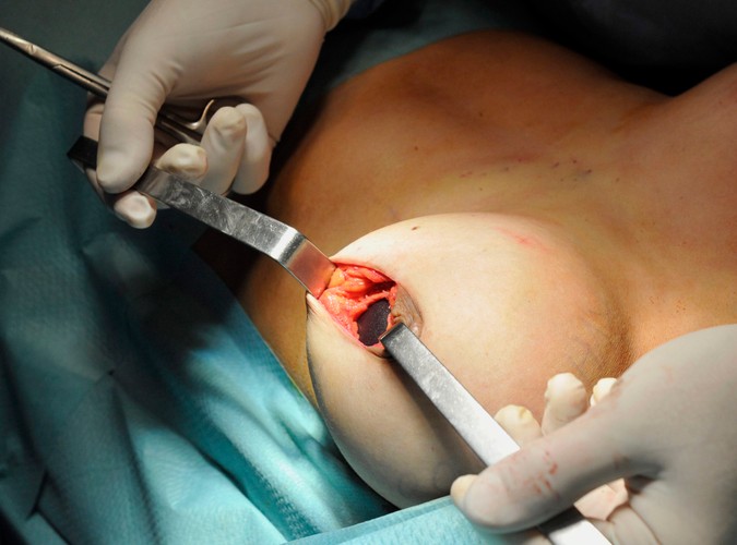 Amerykańska Agencja ds. Żywności i Leków (FDA) już prawie 12 lat temu ostrzegała francuską firmę PIP przed produkcją i sprzedażą silikonowych implantów piersi. Powodem były ich poważne wady.