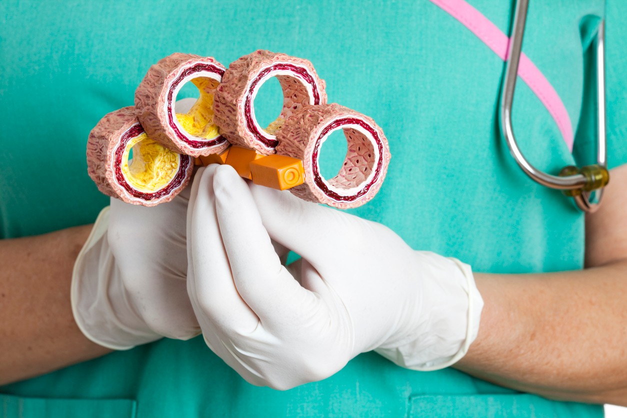 Ateroskleróza napadá vaše cievy. (ilustračné foto)