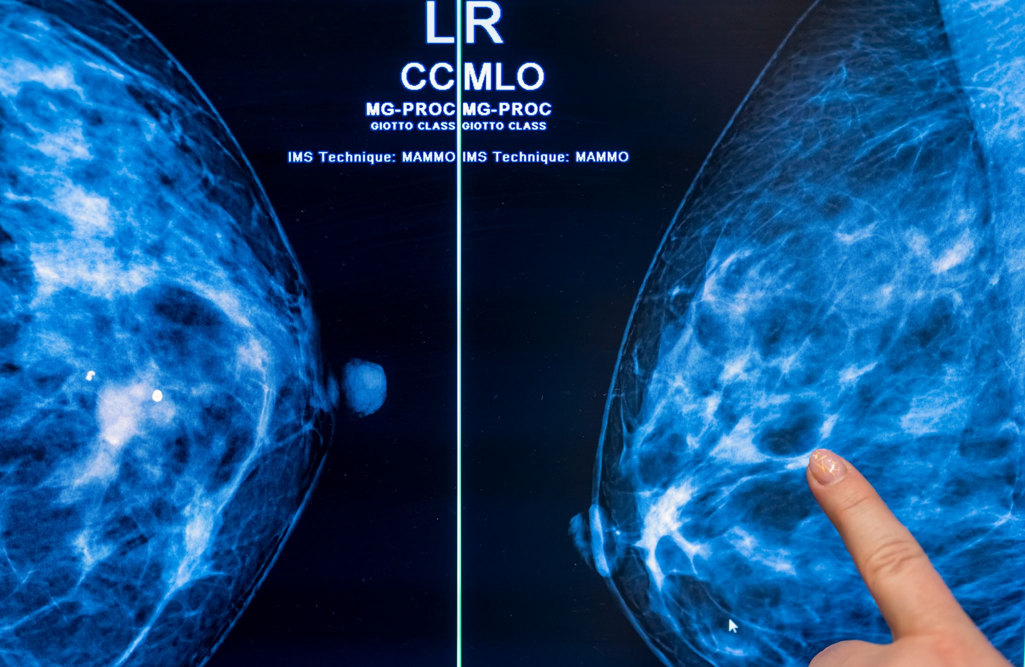 Mammografie-Screening senkt Brustkrebs-Sterblichkeit um 20%