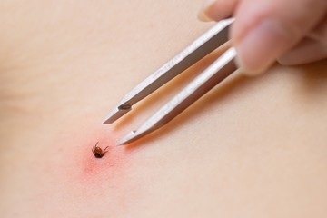 A kullancs kiszedése speciális kullancs eltávolító csipesz segítségével történik (kanál is jár hozzá), jobb híján elég egy szemöldökcsipesz is. A művelethez nem kell orvoshoz menni, a kullancs kiszedése házilag is kivitelezhető.