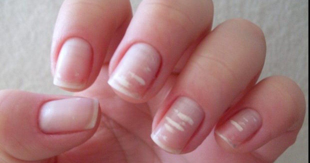 This is what white marks on fingernails say about your health Pulse Ghana