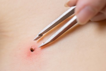 A kullancs kiszedése speciális kullancs eltávolító csipesz segítségével történik (kanál is jár hozzá), jobb híján elég egy szemöldökcsipesz is. A művelethez nem kell orvoshoz menni, a kullancs kiszedése házilag is kivitelezhető.