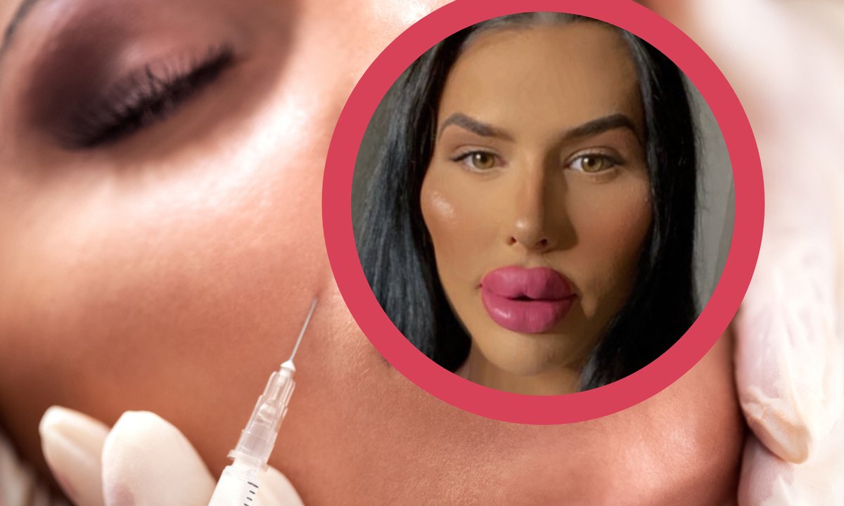 Ma największe usta w Wielkiej Brytanii. Na zabiegi wydała 500 tys. zł