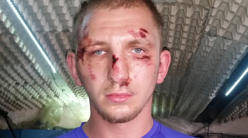 24-letni Kamil oskarża policjantów ze Słupska o brutalne pobicie