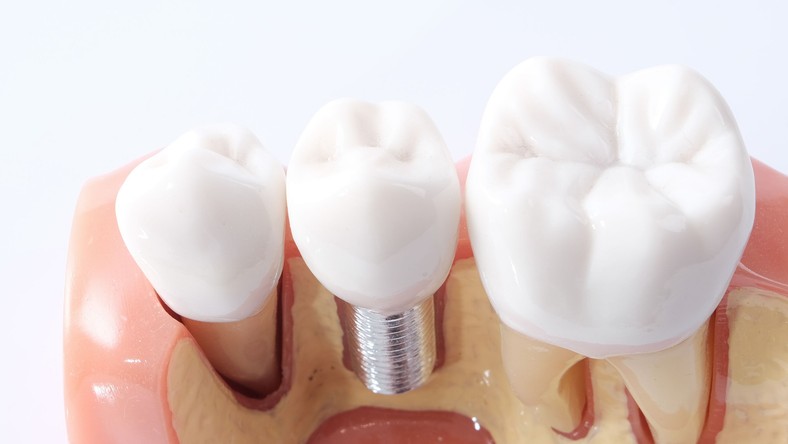 Jaka jest różnica między implantem a koroną? - Dziennik.pl