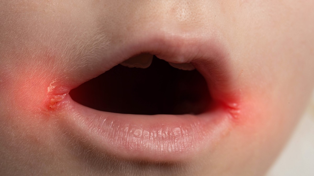 Impetigo na licu najpre počinje oko usta i nosa