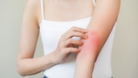 Gyermekek tízezreit érinti Magyarországon – így rontja az életminőséget az atópiás dermatitisz című cikk nyitóképe