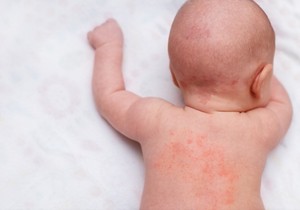 Milijarija rubra, poznata i kao „osip od vrućine”, najčešći je oblik toplotnog osipa