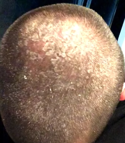 He revealed that his scalp was full of dandruff for years.