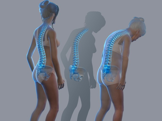 Posledice osteoporoze na ženskom telu