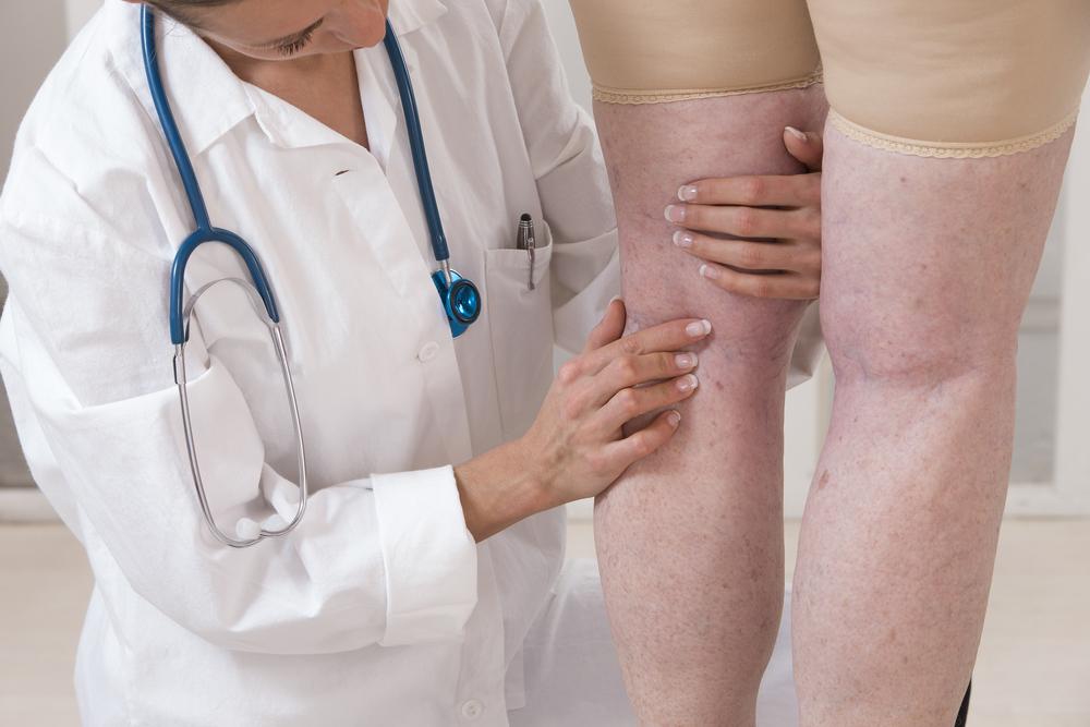 a lábak mélyvénáinak visszeres tünetei