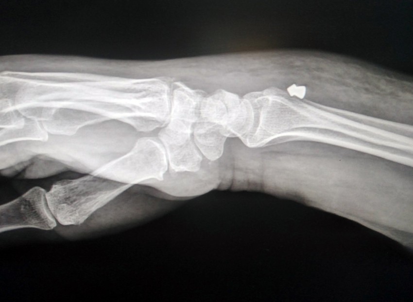 metak zaglavljen u Zdravkinoj ruci