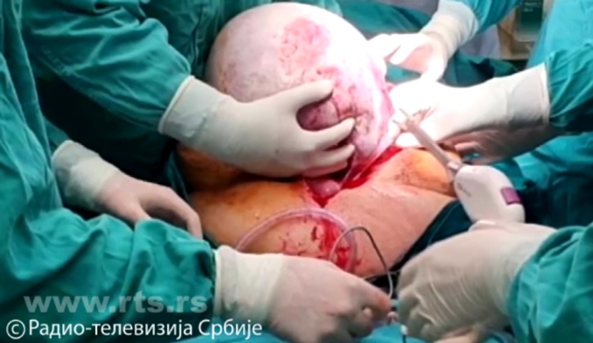 Odstranili joj tumor težak 50 kilograma!