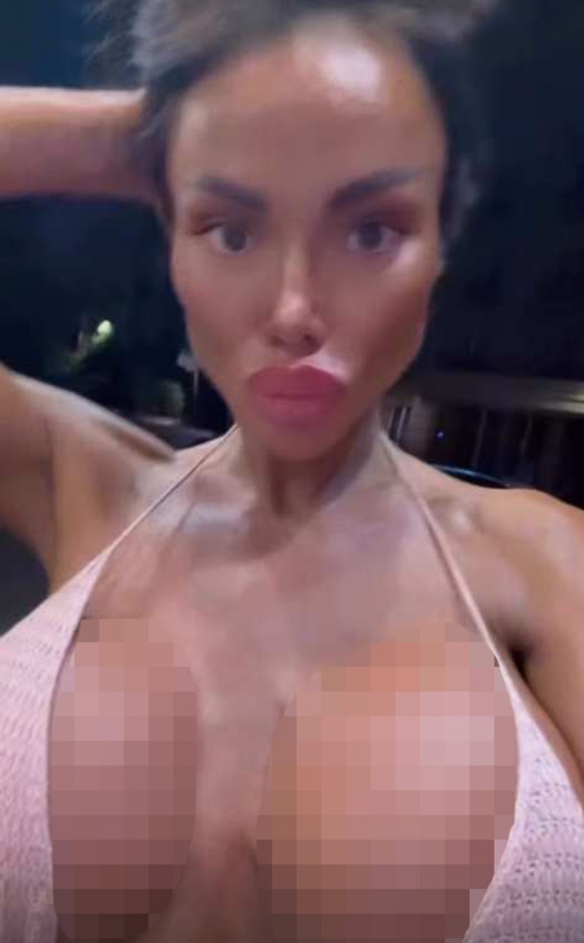 Straleta izvadila silikone, pa ih vratila i izazvala reakcije zbog prenaglašenih oblina: "Imala sam 100 operacija"