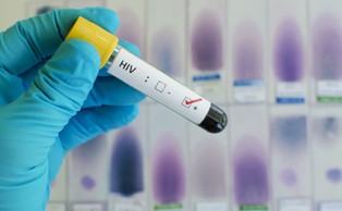 Wirus HIV zwiększa ryzyko ciężkiego przebiegu Covid-19 [BADANIE]