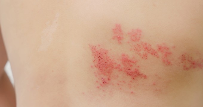 Övsömör (Herpes varicella zoster)
