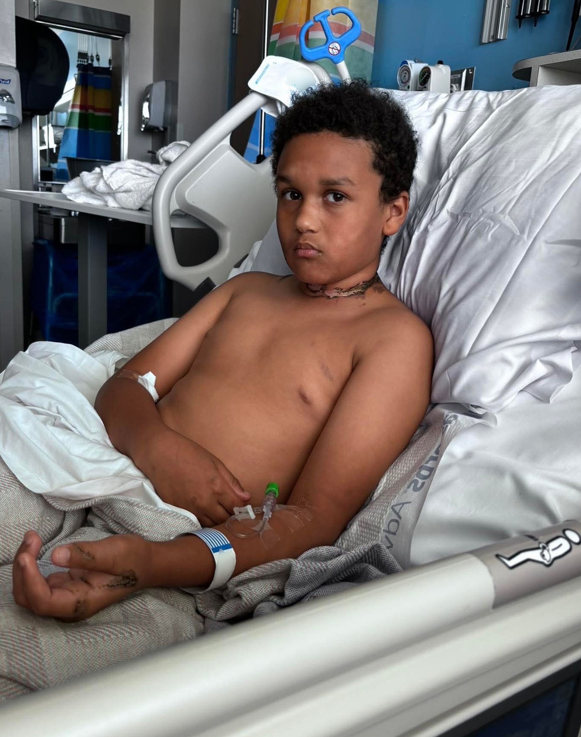 Ashtyn utrpel rozsiahle popáleniny.