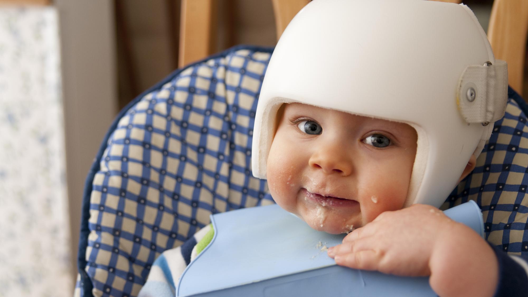 Remodelačná helma, ortéza, vytvaruje deťom preležanú hlavičku či iné  deformácie: Kedy a prečo je potrebná špeciálna prilba, vysvetľuje  neurologička | Najmama.sk