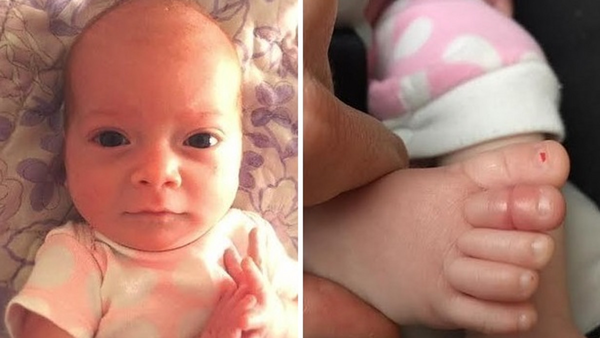 Scott Walker z Kansas w Stanach Zjednoczonych umieścił w sieci zdjęcie spuchniętego palca swojej maleńkiej córeczki. Okazało się, że przyczyną opuchlizny był włos owinięty wokół jej palca. "Chciałem ostrzec innych rodziców przed podobnymi sytuacjami" – napisał pan Walker.