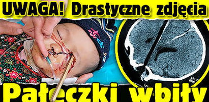 Pałeczki wbiły mu się w oko. Drastyczne zdjęcia