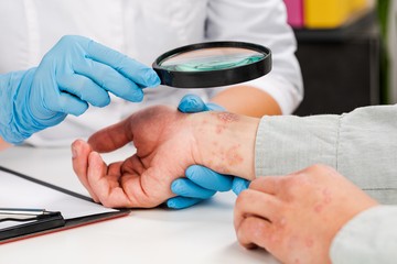 bőrszárazság, bőrviszketés, ekcéma, dermatitis, atópia, exogén ekcéma, endogén ekcéma, bakteriális felülfertőződés, allergiateszt