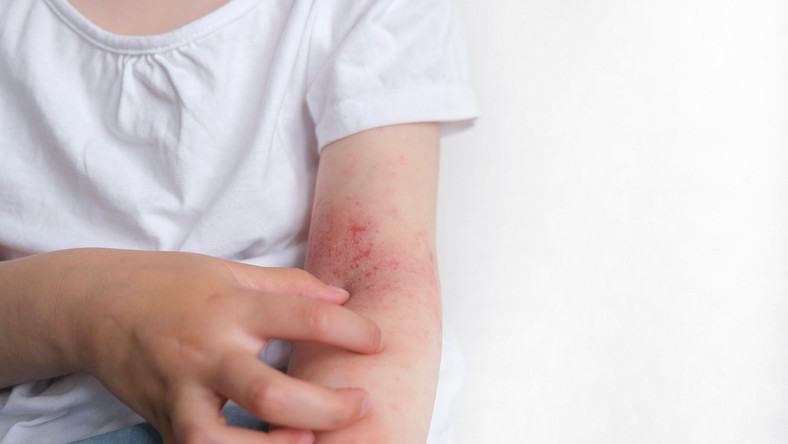 Dziecko drapie skórę, alergia