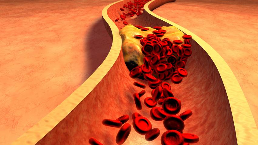 koleszterinszint, koleszterin, magas koleszterin, szívbetegség, trombózis, stroke, szívinfarktus, infarktus