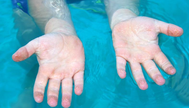 A középső ujj ízületei Nyeregízületi artrózis