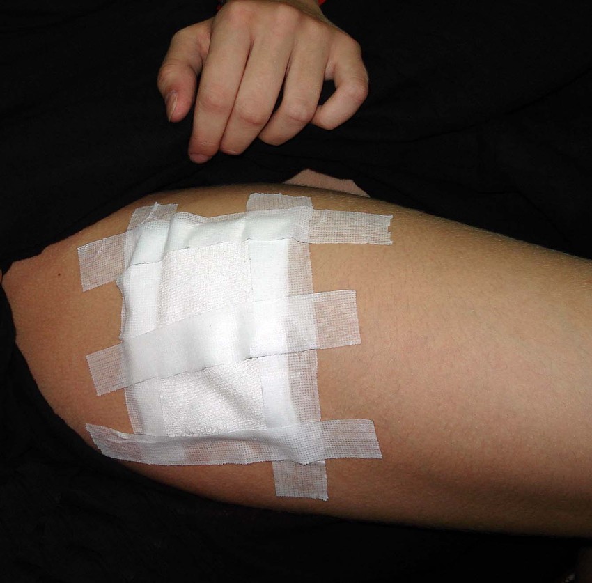 Ušivena rana na butini Milice MItrović