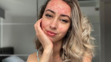 25-latka cierpi na łuszczycę. "Nienawidziłam swojej skóry"