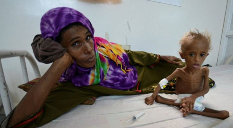 Chłopiec z Jemenu cierpi z głodu
