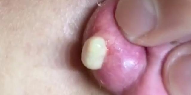 This ear pimple popping video is explosive and horrifying | Pulse Nigeria