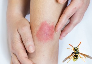 Savetuje se temeljno pranje uboda ose sapunom i vodom