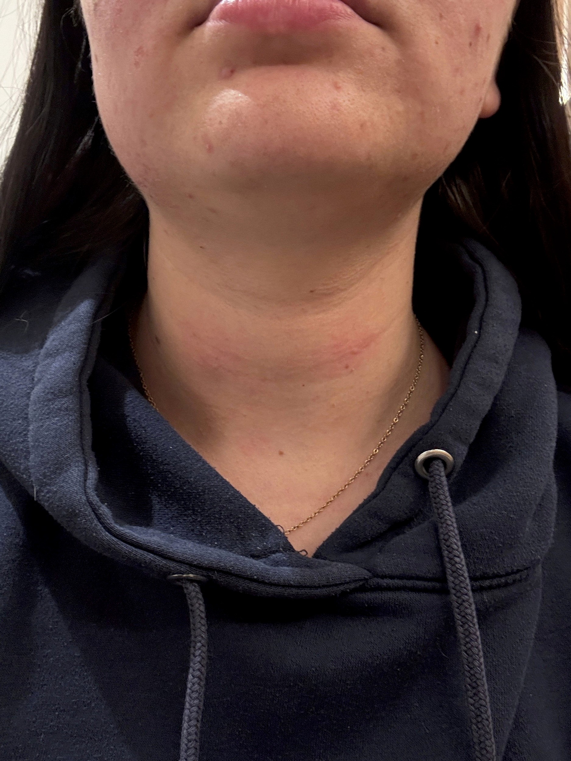 Caitlin okrem neschopnosti grgať trápilo aj nadúvanie a tlak v krku.