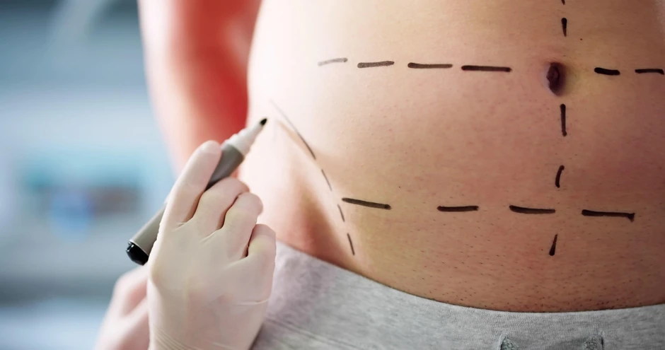 Liposukcija (ilustracija)