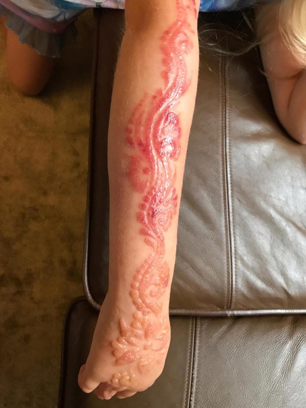 Tattoo wirft schreckliche Blasen