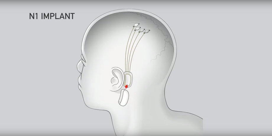 Chip znajduje się za uchem, a elektrody są wprowadzane do mózgu.