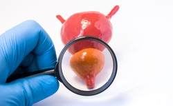 Polska jedynym krajem UE, w którym jest wzrost śmiertelności z powodu raka prostaty