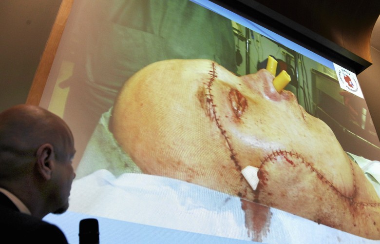 Pierwszy w Polsce pacjent po przeszczepie twarzy