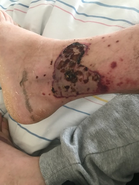 Noga ks. Jerzego po operacji przeszczepu skóry 