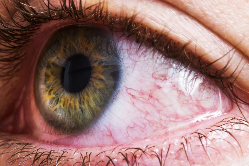 Így jelzi a szemhéj akár a belső cisztát is | EgészségKalauz